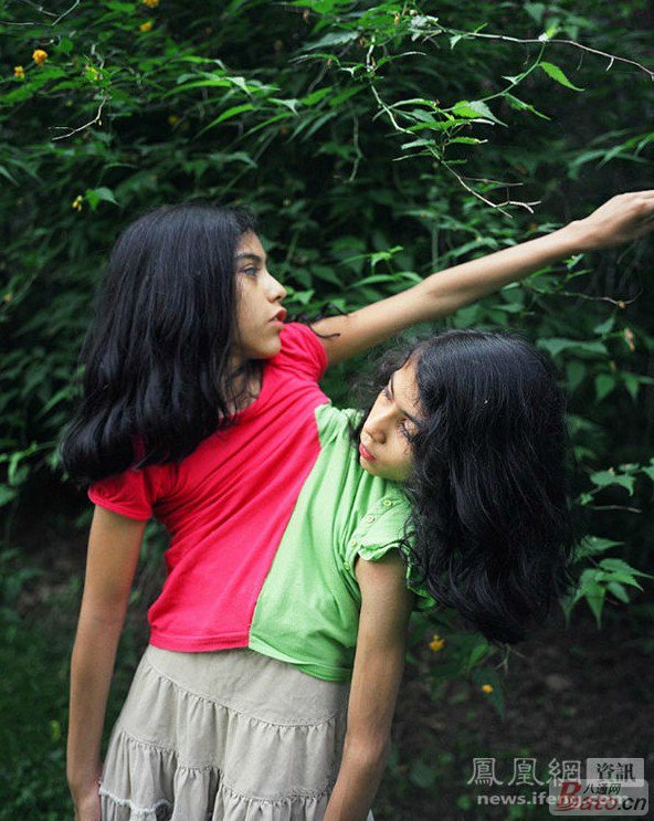 <em>一对</em>连体<em>姐妹的故事</em> 看到这一组照片,惊叹之余